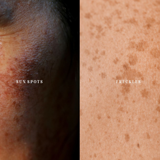 sun spots vs freckles