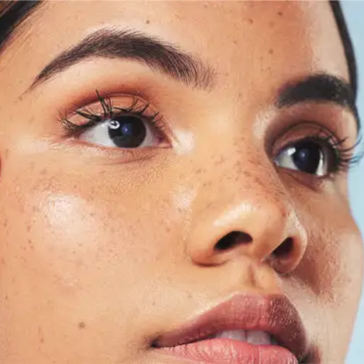 What is Melasma and Why Does it Cause Dark Patches