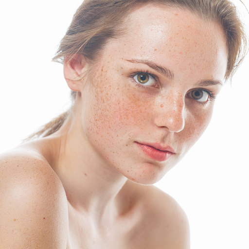 Can Freckles Lead to Skin Cancer