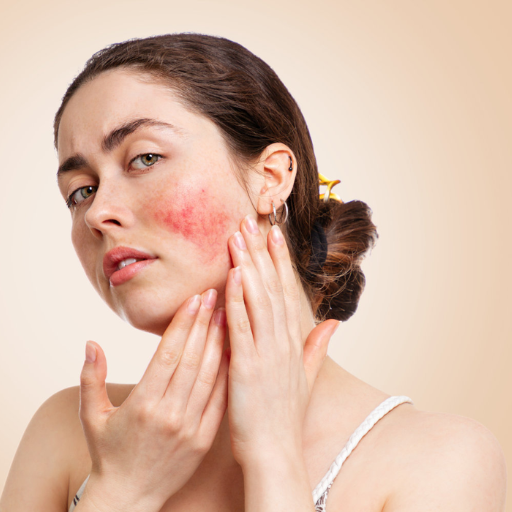 How Can You Calm a Rosacea Flare-Up