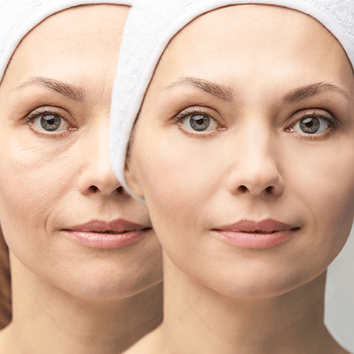 What Causes Eye Bags and Puffiness