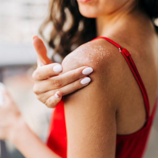 What Causes Sunburn?